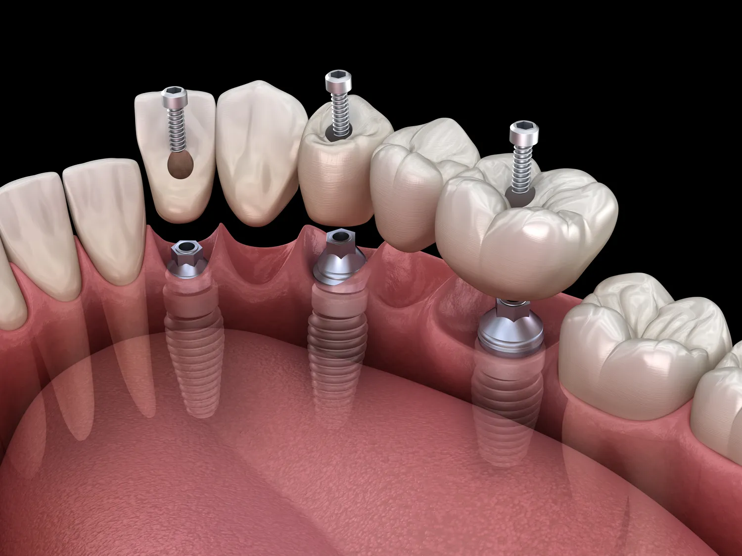 Rodzaje implantów zębowych