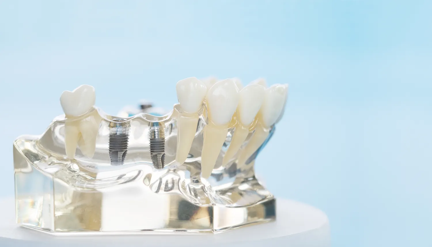 Zabiegi dentystyczne refundowane przez NFZ