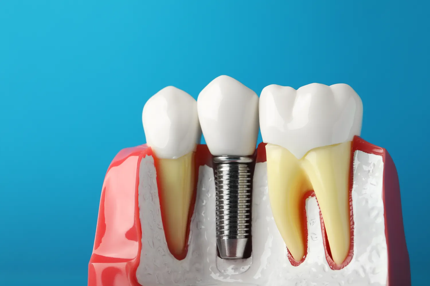 Ranking implantów zębowych – najważniejsze informacje