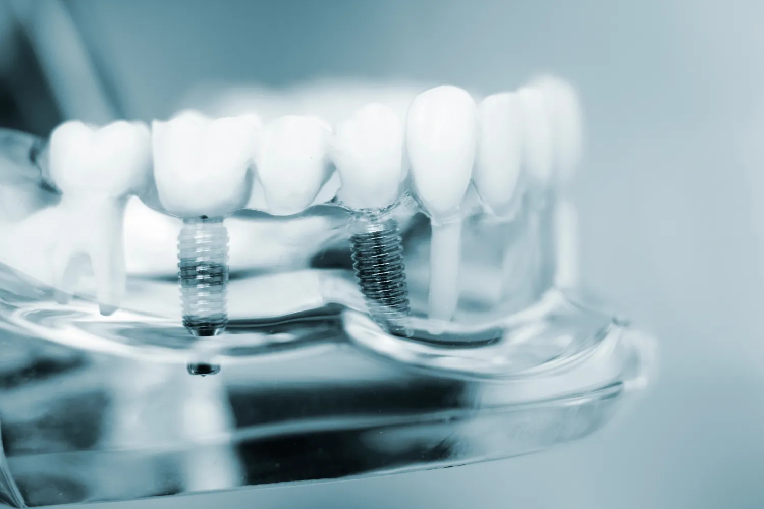 Wszystko co musisz wiedzieć o implantach zębowych