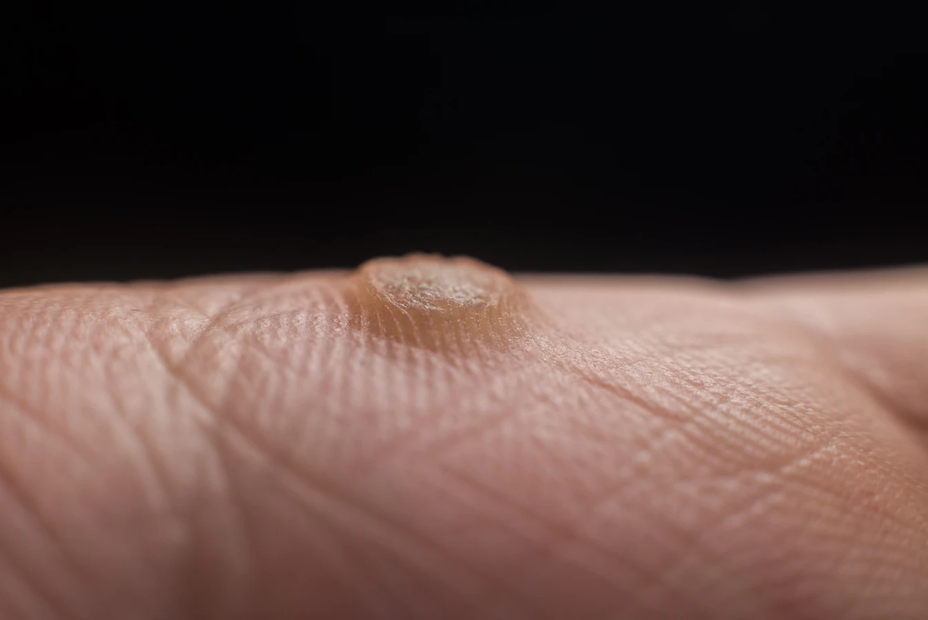 Jak długo trwa leczenie kurzajki?