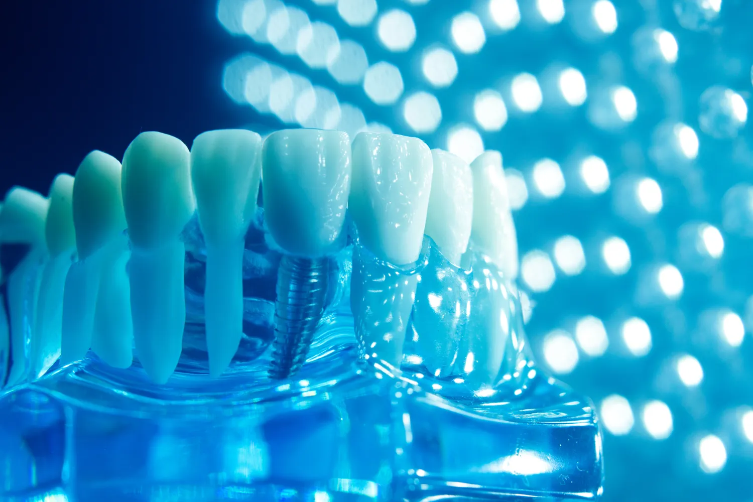 Implanty Czechy czy warto?