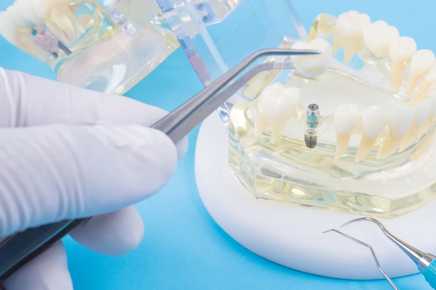 Implanty zębowe – co i jak?