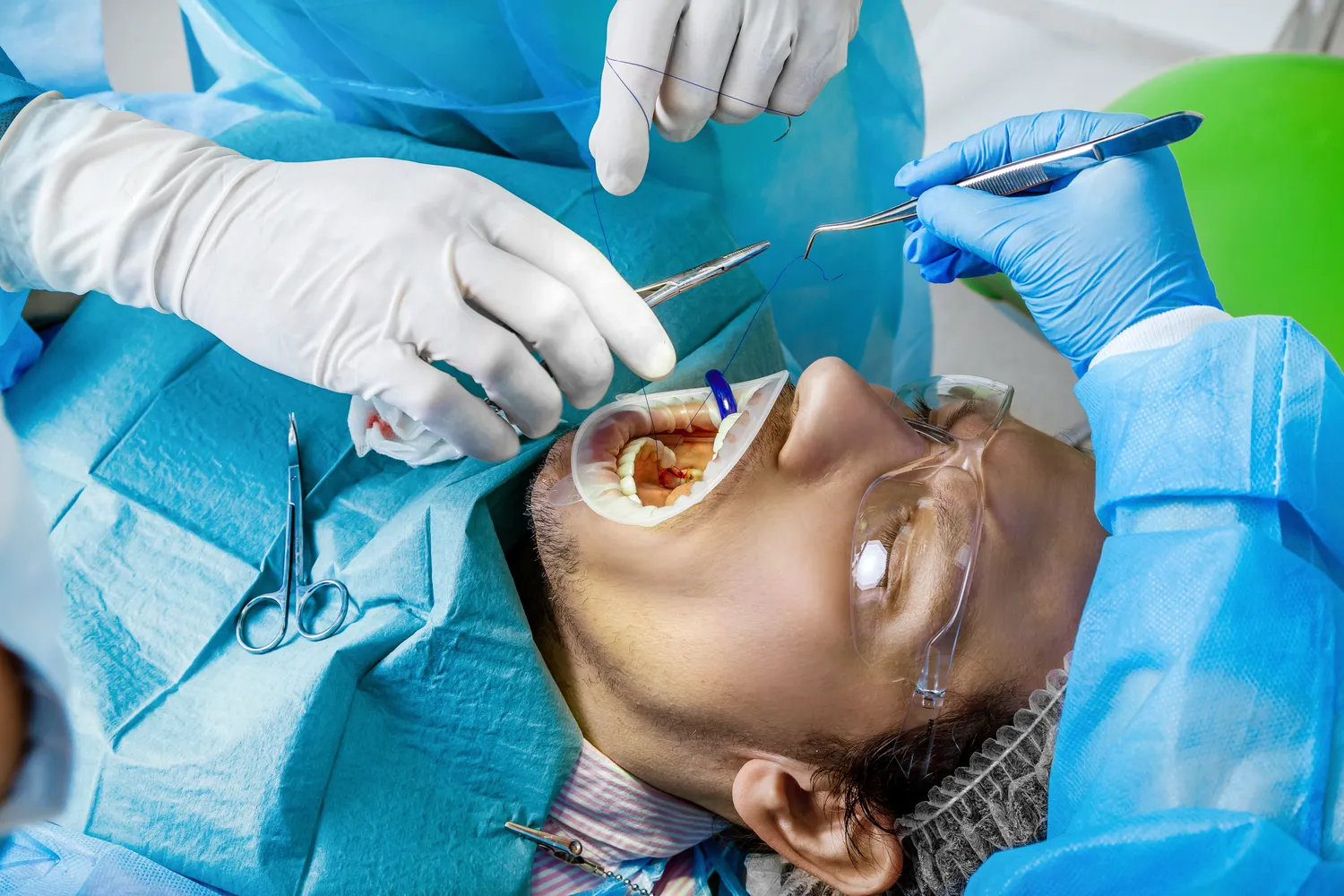 Jak długo goją się implanty?