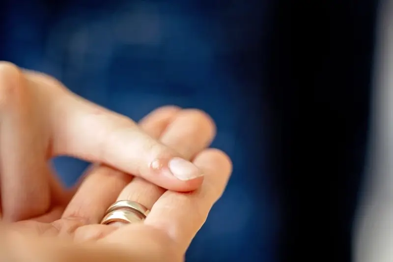 Korzenie kurzajki jak usunąć?